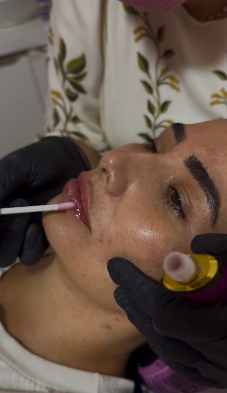 Aplicação de preenchimento labial com luvas pretas